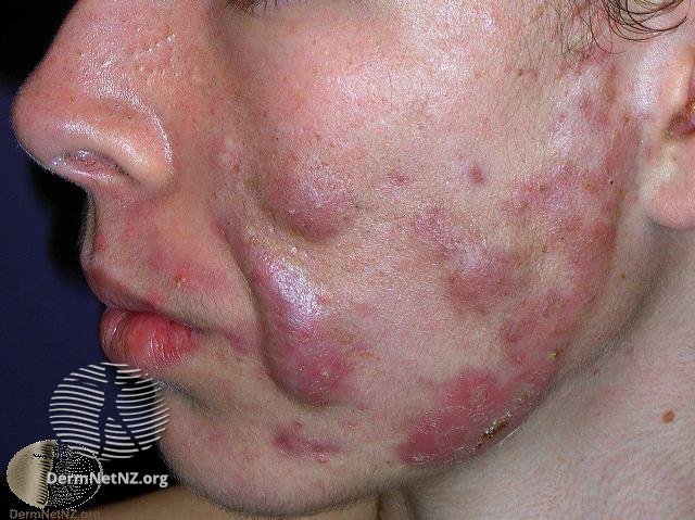 acne severe