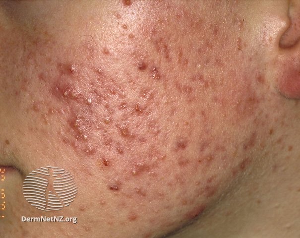 acne severe